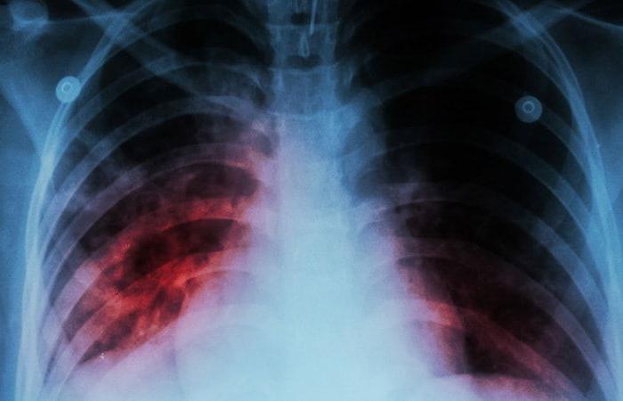 Slight resurgence of tuberculosis in France in 2023