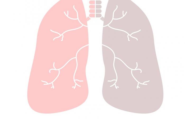 Bronchiolitis | A study confirms the effectiveness of the beyfortus to prevent serious infections
